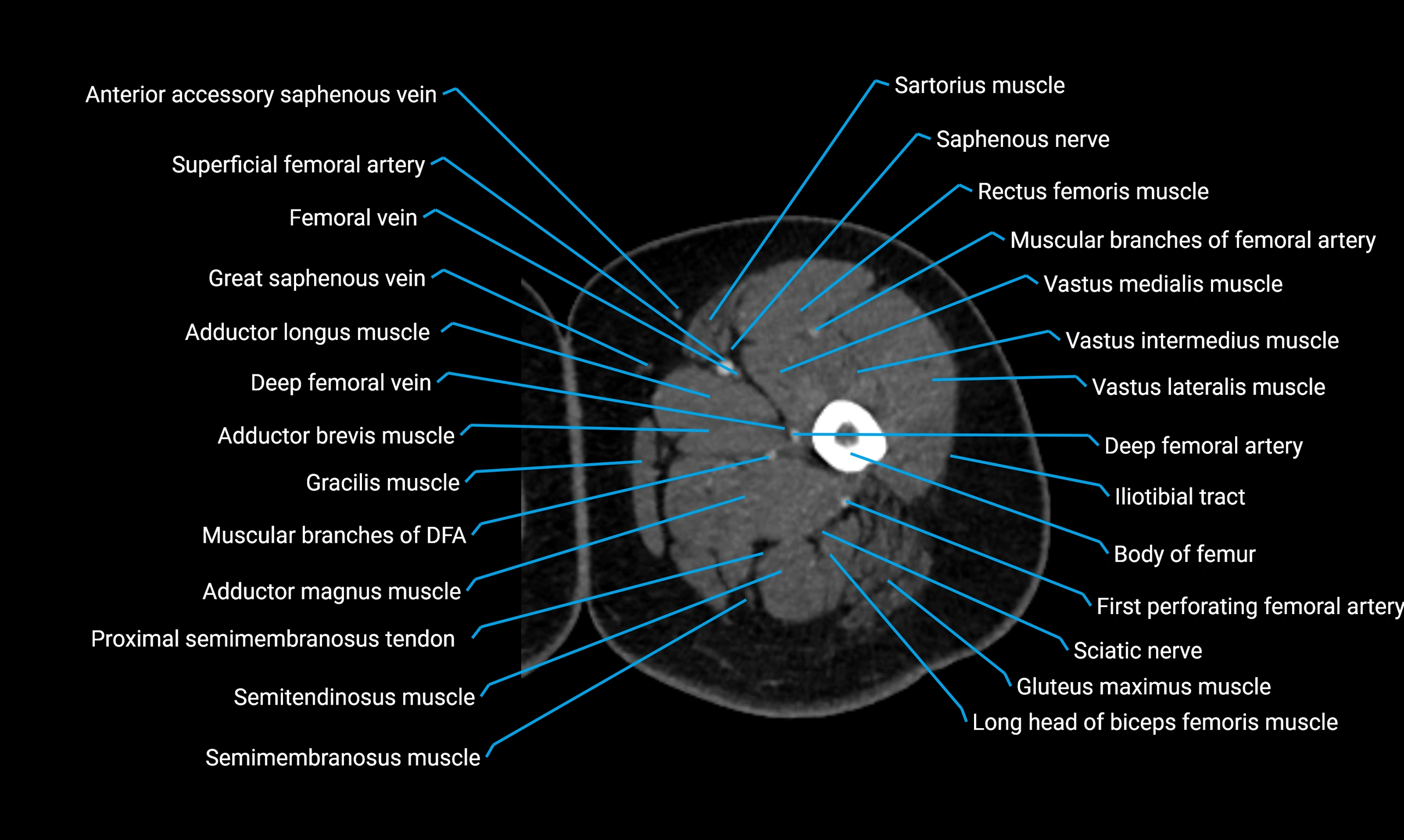 CT thigh axial cross sectional anatomy labelled image_32 (2).webp